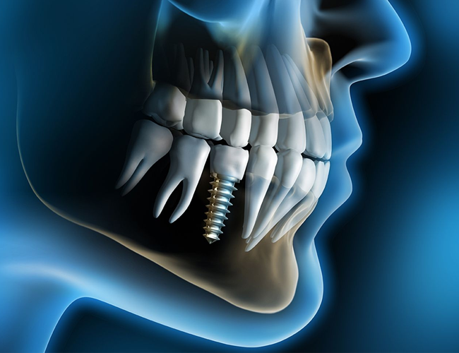 implantes dentários