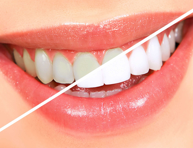 clareamento dental