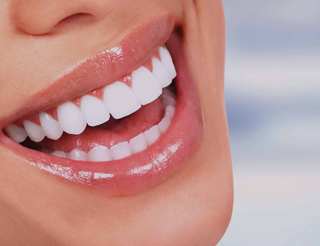 lentes de contato dental